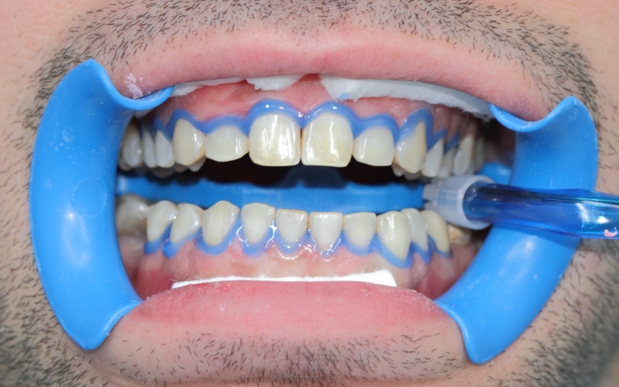 Top Cosmetic Dentistry Procedures